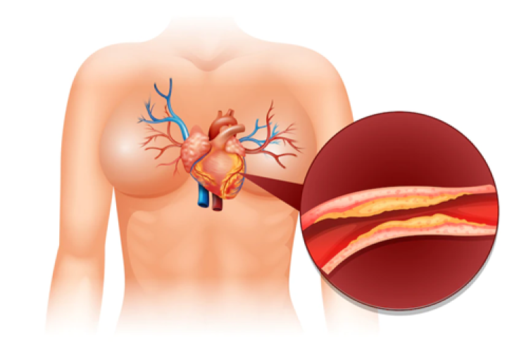 Angioplasty